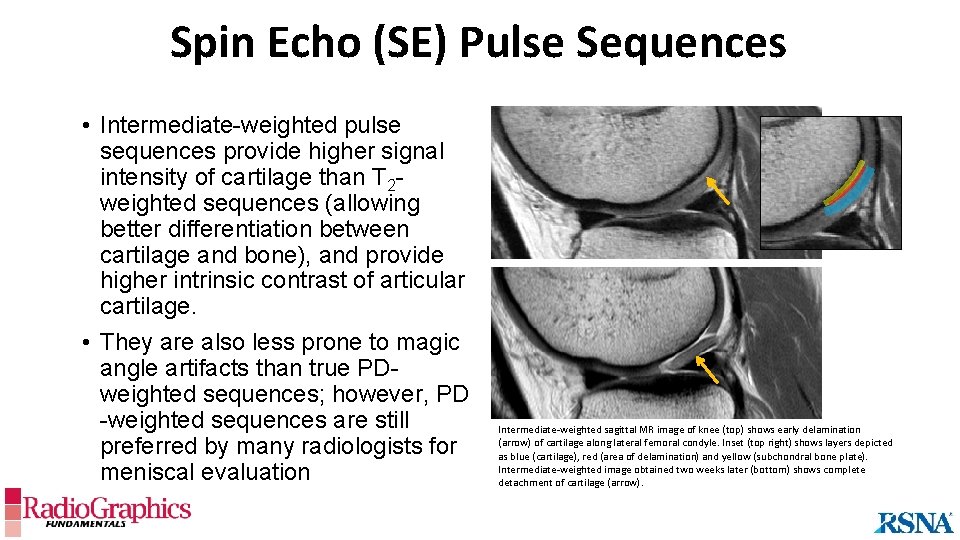 Spin Echo (SE) Pulse Sequences • Intermediate-weighted pulse sequences provide higher signal intensity of