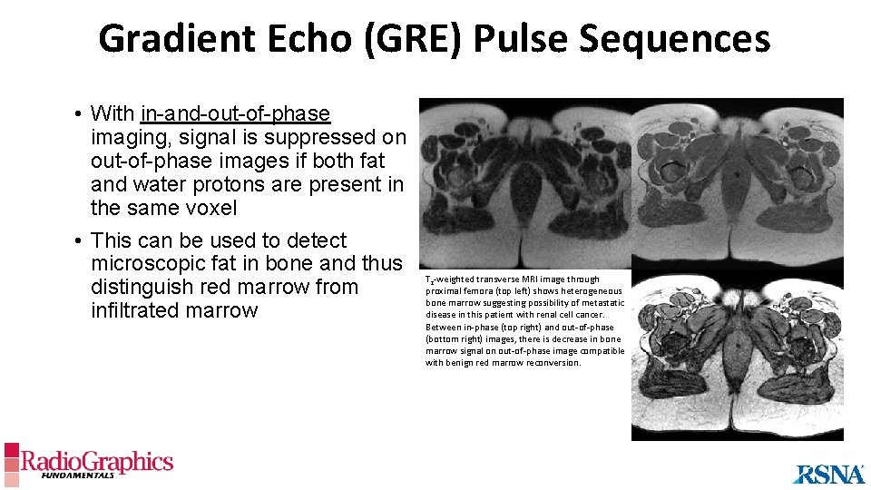 Gradient Echo (GRE) Pulse Sequences • With in-and-out-of-phase imaging, signal is suppressed on out-of-phase