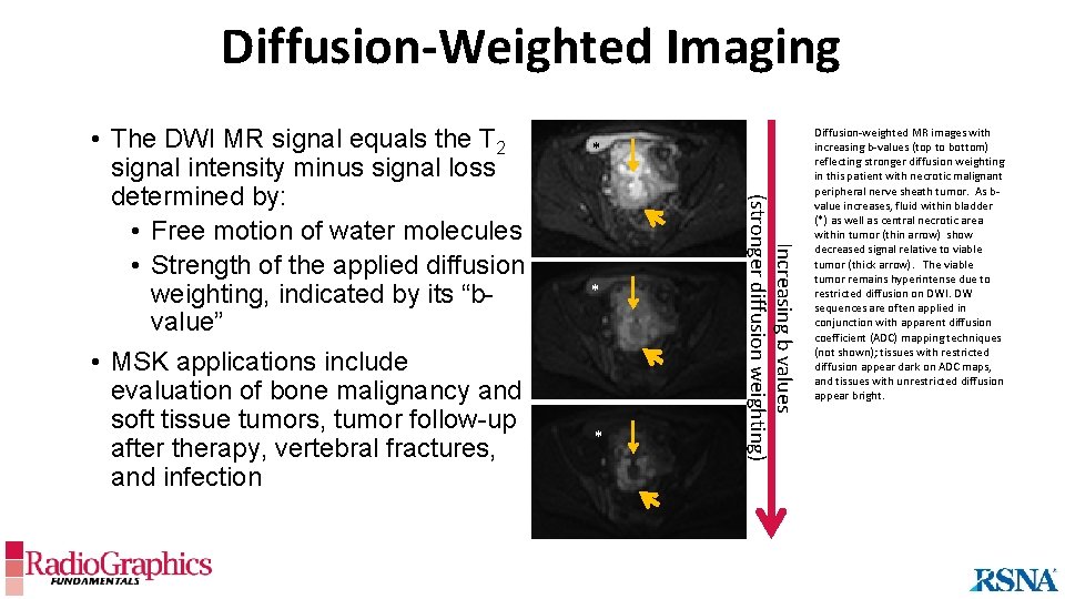Diffusion-Weighted Imaging * * * Increasing b values (stronger diffusion weighting) • The DWI