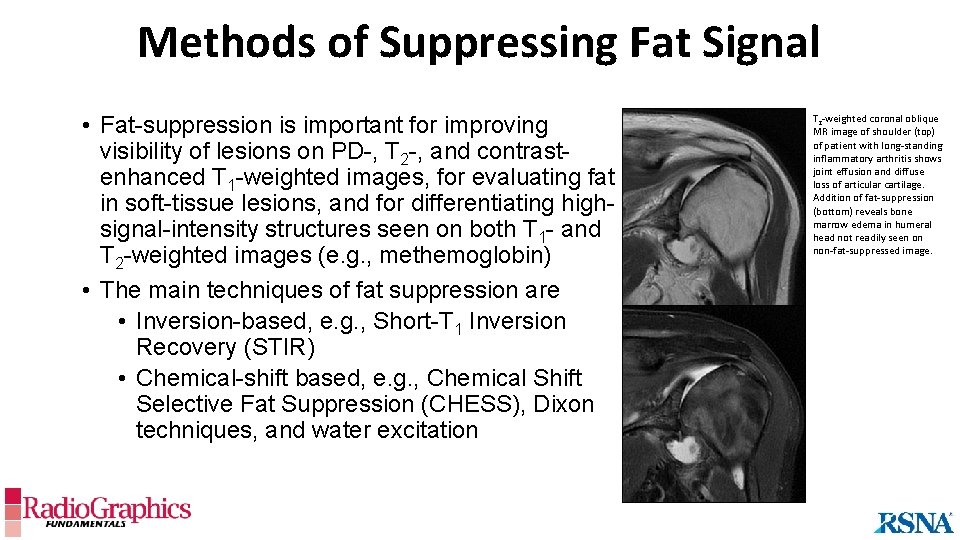 Methods of Suppressing Fat Signal • Fat-suppression is important for improving visibility of lesions
