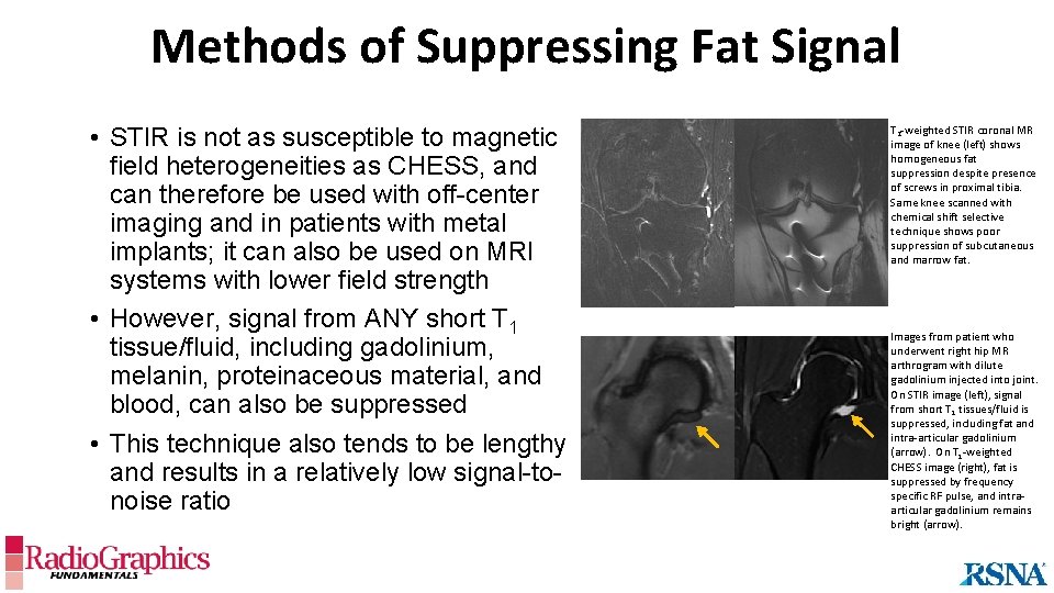 Methods of Suppressing Fat Signal • STIR is not as susceptible to magnetic field