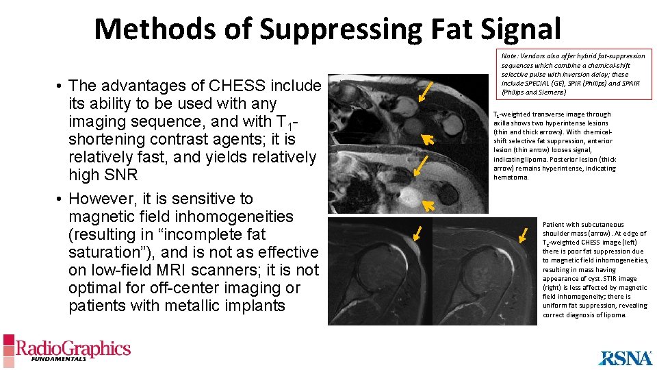 Methods of Suppressing Fat Signal • The advantages of CHESS include its ability to