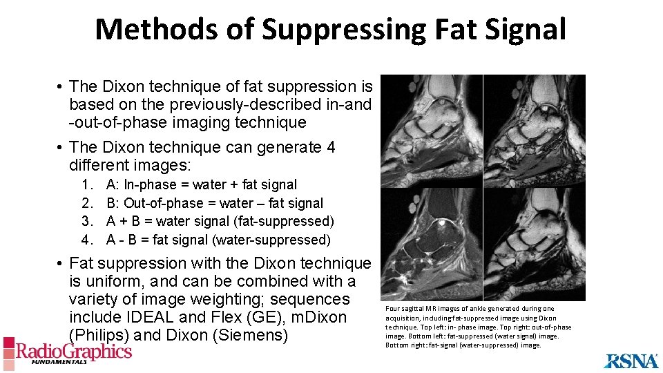 Methods of Suppressing Fat Signal • The Dixon technique of fat suppression is based