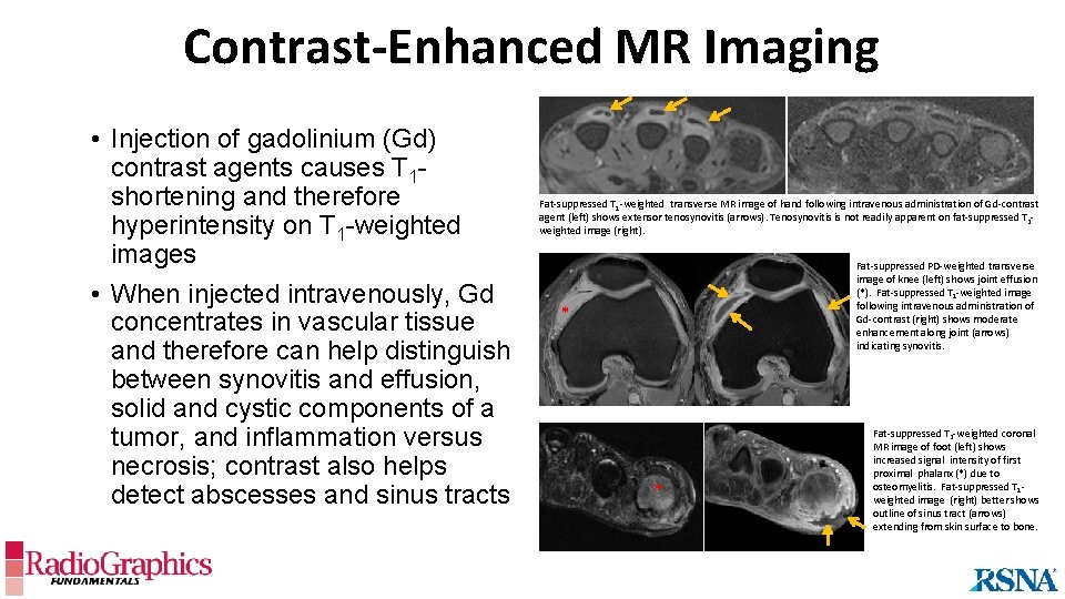 Contrast-Enhanced MR Imaging • Injection of gadolinium (Gd) contrast agents causes T 1 shortening