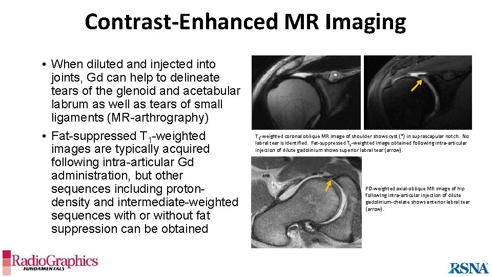 Contrast-Enhanced MR Imaging • When diluted and injected into joints, Gd can help to