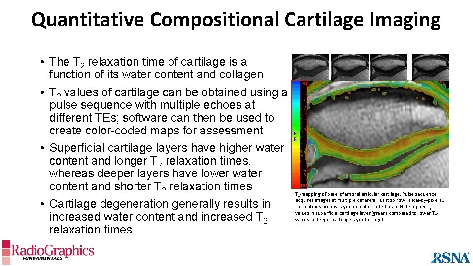 Quantitative Compositional Cartilage Imaging • The T 2 relaxation time of cartilage is a