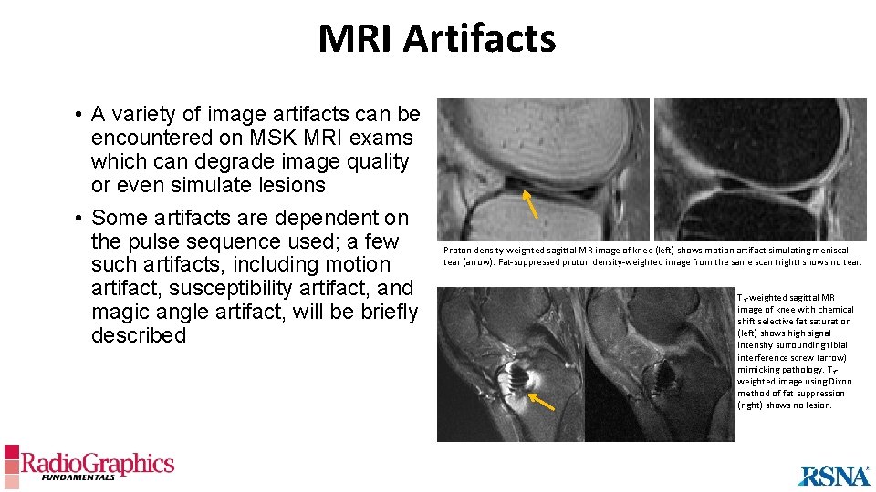 MRI Artifacts • A variety of image artifacts can be encountered on MSK MRI