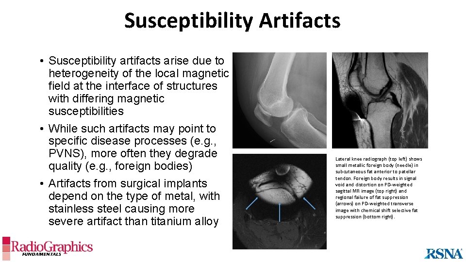 Susceptibility Artifacts • Susceptibility artifacts arise due to heterogeneity of the local magnetic field