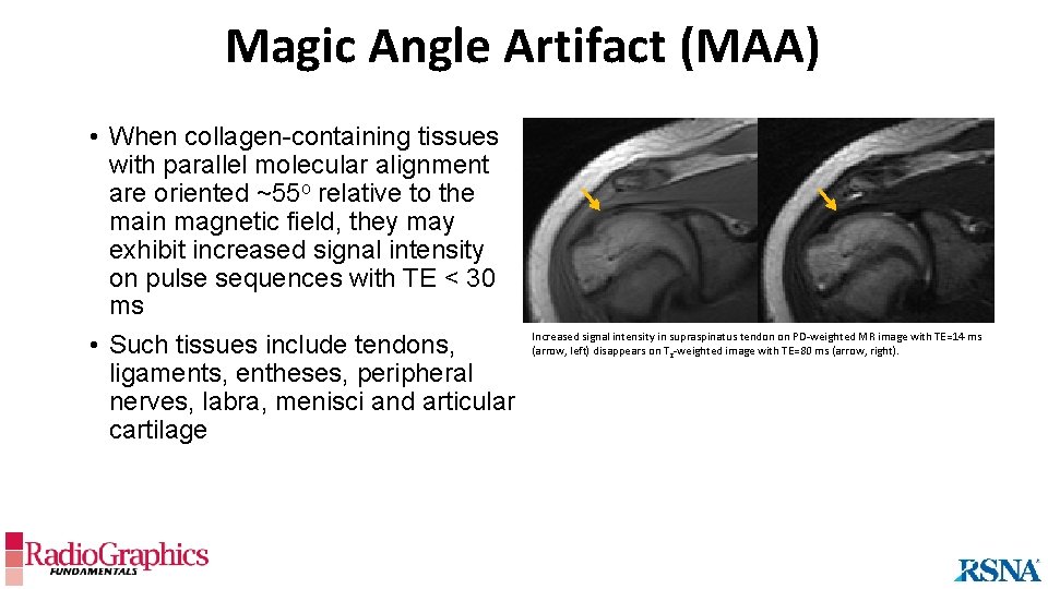 Magic Angle Artifact (MAA) • When collagen-containing tissues with parallel molecular alignment are oriented