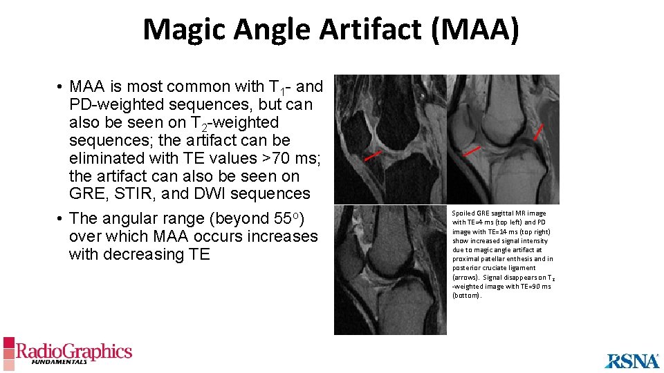 Magic Angle Artifact (MAA) • MAA is most common with T 1 - and