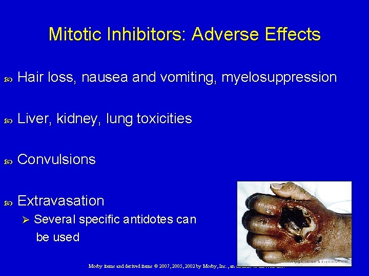 Mitotic Inhibitors: Adverse Effects Hair loss, nausea and vomiting, myelosuppression Liver, kidney, lung toxicities