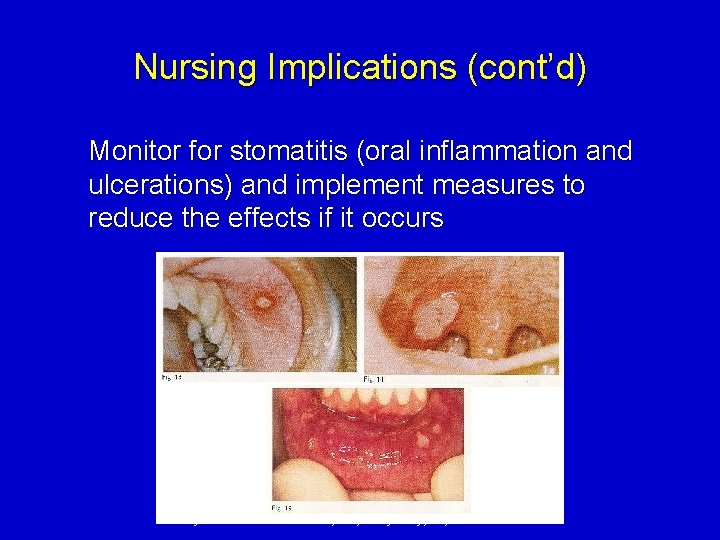 Nursing Implications (cont’d) Monitor for stomatitis (oral inflammation and ulcerations) and implement measures to