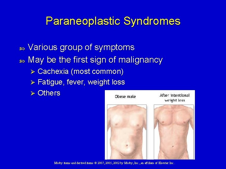 Paraneoplastic Syndromes Various group of symptoms May be the first sign of malignancy Cachexia