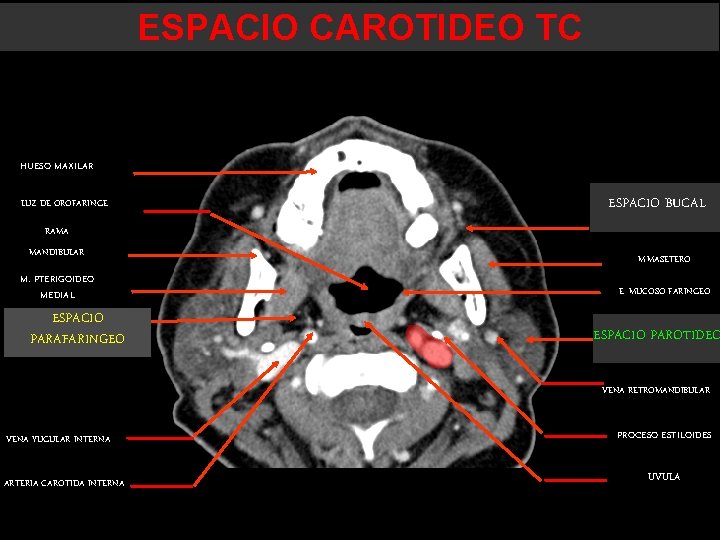 ESPACIO CAROTIDEO TC HUESO MAXILAR LUZ DE OROFARINGE ESPACIO BUCAL RAMA MANDIBULAR M. PTERIGOIDEO ESPACIO CAROTIDEO TC HUESO MAXILAR LUZ DE OROFARINGE ESPACIO BUCAL RAMA MANDIBULAR M. PTERIGOIDEO
