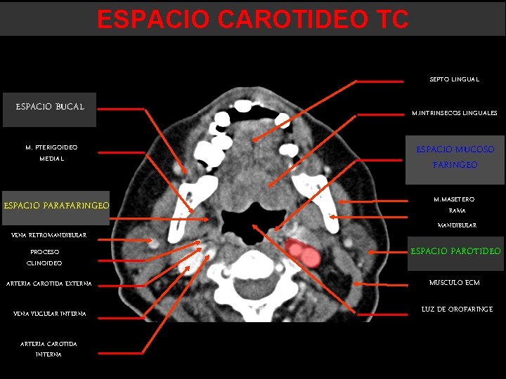 ESPACIO CAROTIDEO TC SEPTO LINGUAL ESPACIO BUCAL M. PTERIGOIDEO MEDIAL ESPACIO PARAFARINGEO VENA RETROMANDIBULAR ESPACIO CAROTIDEO TC SEPTO LINGUAL ESPACIO BUCAL M. PTERIGOIDEO MEDIAL ESPACIO PARAFARINGEO VENA RETROMANDIBULAR