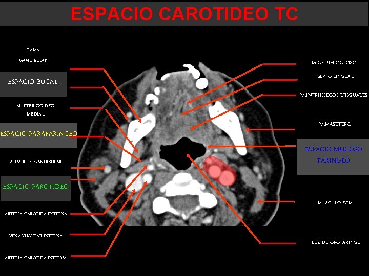 ESPACIO CAROTIDEO TC RAMA MANDIBULAR ESPACIO BUCAL M GENIHIOGLOSO SEPTO LINGUAL M. INTRINSECOS LINGUALES ESPACIO CAROTIDEO TC RAMA MANDIBULAR ESPACIO BUCAL M GENIHIOGLOSO SEPTO LINGUAL M. INTRINSECOS LINGUALES