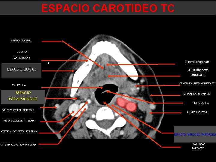 ESPACIO CAROTIDEO TC SEPTO LINGUAL CUERPO MANDIBULAR ESPACIO BUCAL VALECULA ESPACIO PARAFARINGEO VENA YUGULAR ESPACIO CAROTIDEO TC SEPTO LINGUAL CUERPO MANDIBULAR ESPACIO BUCAL VALECULA ESPACIO PARAFARINGEO VENA YUGULAR