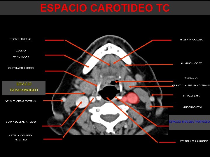 ESPACIO CAROTIDEO TC SEPTO LINGUAL M GENIHIOGLOSO CUERPO MANDIBULAR CARTILAGO HIODES M. MILOHIODEO VALECULA ESPACIO CAROTIDEO TC SEPTO LINGUAL M GENIHIOGLOSO CUERPO MANDIBULAR CARTILAGO HIODES M. MILOHIODEO VALECULA