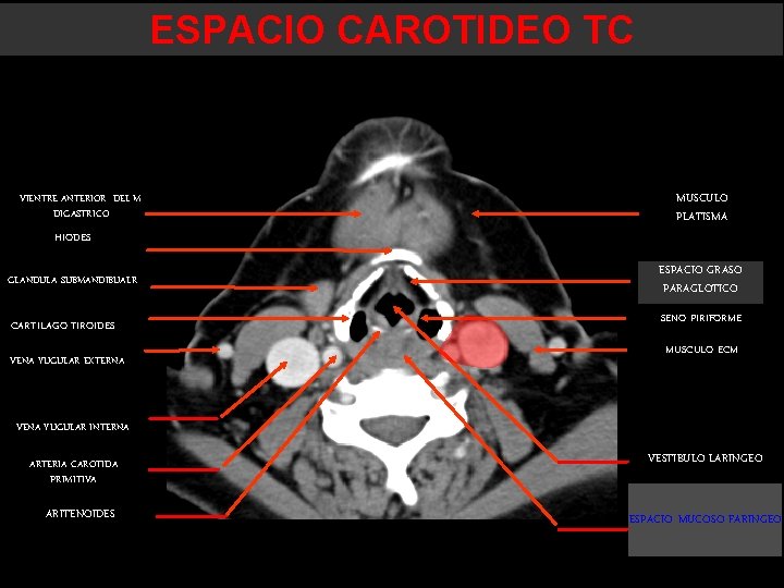 ESPACIO CAROTIDEO TC VIENTRE ANTERIOR DEL M. DIGASTRICO MUSCULO PLATISMA HIODES GLANDULA SUBMANDIBUALR CARTILAGO ESPACIO CAROTIDEO TC VIENTRE ANTERIOR DEL M. DIGASTRICO MUSCULO PLATISMA HIODES GLANDULA SUBMANDIBUALR CARTILAGO