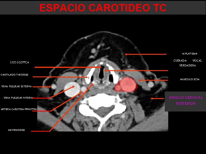 ESPACIO CAROTIDEO TC M. PLATISMA LUZ GLOTICA CARTILAGO TIROIDES CUERADA VOCAL VERDADERA MUSCULO ECM ESPACIO CAROTIDEO TC M. PLATISMA LUZ GLOTICA CARTILAGO TIROIDES CUERADA VOCAL VERDADERA MUSCULO ECM