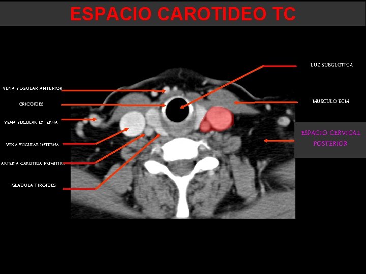 ESPACIO CAROTIDEO TC LUZ SUBGLOTICA VENA YUGULAR ANTERIOR CRICOIDES MUSCULO ECM VENA YUGULAR EXTERNA ESPACIO CAROTIDEO TC LUZ SUBGLOTICA VENA YUGULAR ANTERIOR CRICOIDES MUSCULO ECM VENA YUGULAR EXTERNA
