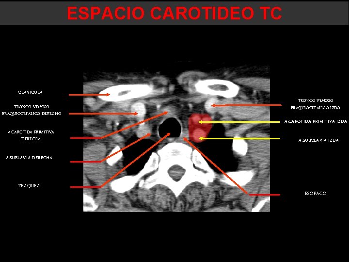 ESPACIO CAROTIDEO TC CLAVICULA TRONCO VENOSO BRAQUIOCEFALICO DERECHO A. CAROTIDA PRIMITIVA DERECHA TRONCO VENOSO ESPACIO CAROTIDEO TC CLAVICULA TRONCO VENOSO BRAQUIOCEFALICO DERECHO A. CAROTIDA PRIMITIVA DERECHA TRONCO VENOSO