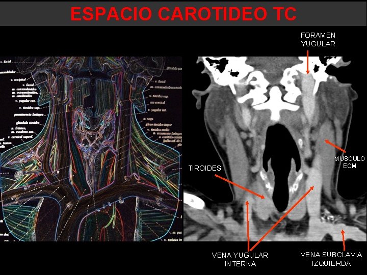 ESPACIO CAROTIDEO TC FORAMEN YUGULAR TIROIDES VENA YUGULAR INTERNA MUSCULO ECM VENA SUBCLAVIA IZQUIERDA ESPACIO CAROTIDEO TC FORAMEN YUGULAR TIROIDES VENA YUGULAR INTERNA MUSCULO ECM VENA SUBCLAVIA IZQUIERDA