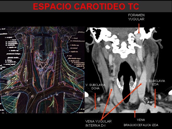ESPACIO CAROTIDEO TC FORAMEN YUGULAR V. SUBCLAVIA IZDA V. SUBCLAVIA DCHA VENA YUGULAR INTERNA ESPACIO CAROTIDEO TC FORAMEN YUGULAR V. SUBCLAVIA IZDA V. SUBCLAVIA DCHA VENA YUGULAR INTERNA