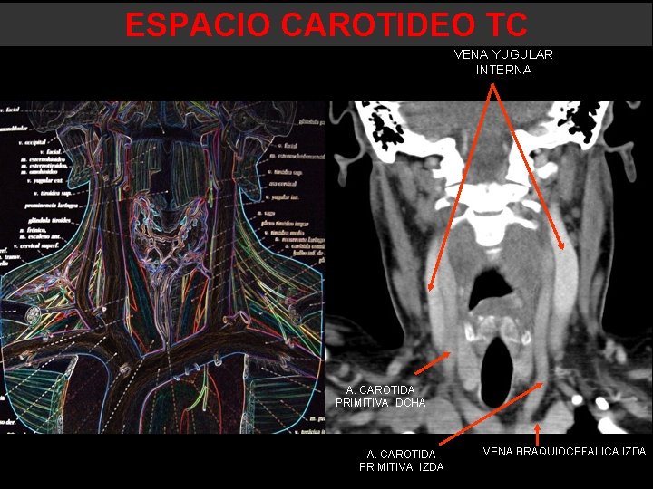ESPACIO CAROTIDEO TC VENA YUGULAR INTERNA A. CAROTIDA PRIMITIVA DCHA A. CAROTIDA PRIMITIVA IZDA ESPACIO CAROTIDEO TC VENA YUGULAR INTERNA A. CAROTIDA PRIMITIVA DCHA A. CAROTIDA PRIMITIVA IZDA