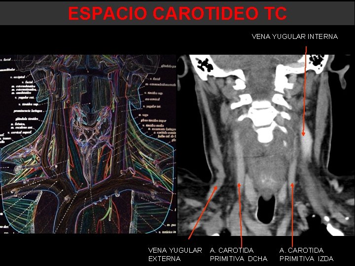 ESPACIO CAROTIDEO TC VENA YUGULAR INTERNA VENA YUGULAR EXTERNA A. CAROTIDA PRIMITIVA DCHA A. ESPACIO CAROTIDEO TC VENA YUGULAR INTERNA VENA YUGULAR EXTERNA A. CAROTIDA PRIMITIVA DCHA A.