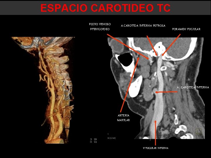 ESPACIO CAROTIDEO TC PLEXO VENOSO PTERIGOIDEO A. CAROTIDA INTERNA PETROSA FORAMEN YUGULAR A. CAROTIDA ESPACIO CAROTIDEO TC PLEXO VENOSO PTERIGOIDEO A. CAROTIDA INTERNA PETROSA FORAMEN YUGULAR A. CAROTIDA