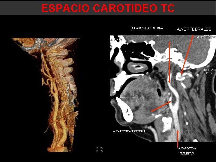 ESPACIO CAROTIDEO TC A. CAROTIDA INTERNA A. VERTEBRALES A. CAROTIDA EXTERNA A. CAROTIDA PRIMITIVA ESPACIO CAROTIDEO TC A. CAROTIDA INTERNA A. VERTEBRALES A. CAROTIDA EXTERNA A. CAROTIDA PRIMITIVA