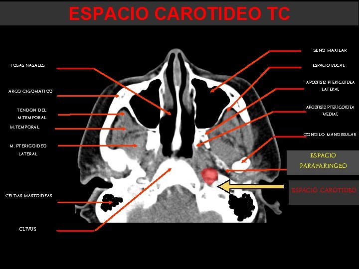 ESPACIO CAROTIDEO TC SENO MAXILAR FOSAS NASALES ARCO CIGOMATICO TENDON DEL M. TEMPORAL M. ESPACIO CAROTIDEO TC SENO MAXILAR FOSAS NASALES ARCO CIGOMATICO TENDON DEL M. TEMPORAL M.