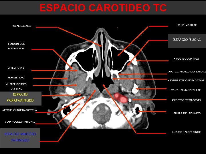 ESPACIO CAROTIDEO TC FOSAS NASALES TENDON DEL M. TEMPORAL SENO MAXILAR ESPACIO BUCAL ARCO ESPACIO CAROTIDEO TC FOSAS NASALES TENDON DEL M. TEMPORAL SENO MAXILAR ESPACIO BUCAL ARCO