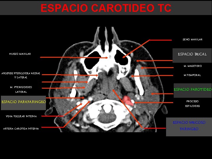 ESPACIO CAROTIDEO TC SENO MAXILAR HUESO MAXILAR ESPACIO BUCAL M. MASETERO APOSFISIS PTERIGOIDEA MEDIAL ESPACIO CAROTIDEO TC SENO MAXILAR HUESO MAXILAR ESPACIO BUCAL M. MASETERO APOSFISIS PTERIGOIDEA MEDIAL