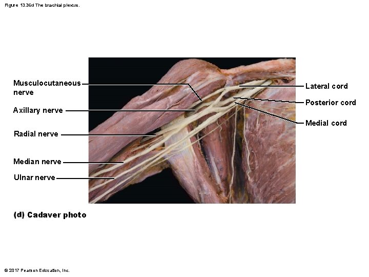 Figure 13. 36 d The brachial plexus. Musculocutaneous nerve Axillary nerve Lateral cord Posterior