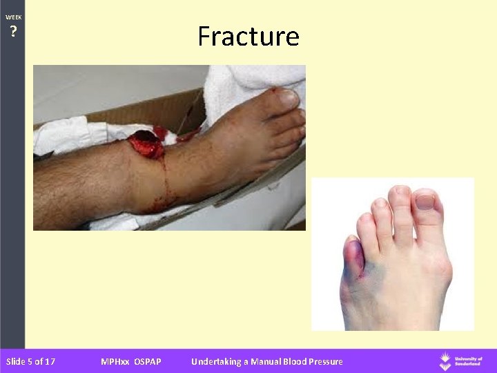 WEEK Fracture ? Slide 5 of 17 MPHxx OSPAP Undertaking a Manual Blood Pressure