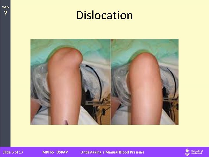 WEEK Dislocation ? Slide 6 of 17 MPHxx OSPAP Undertaking a Manual Blood Pressure