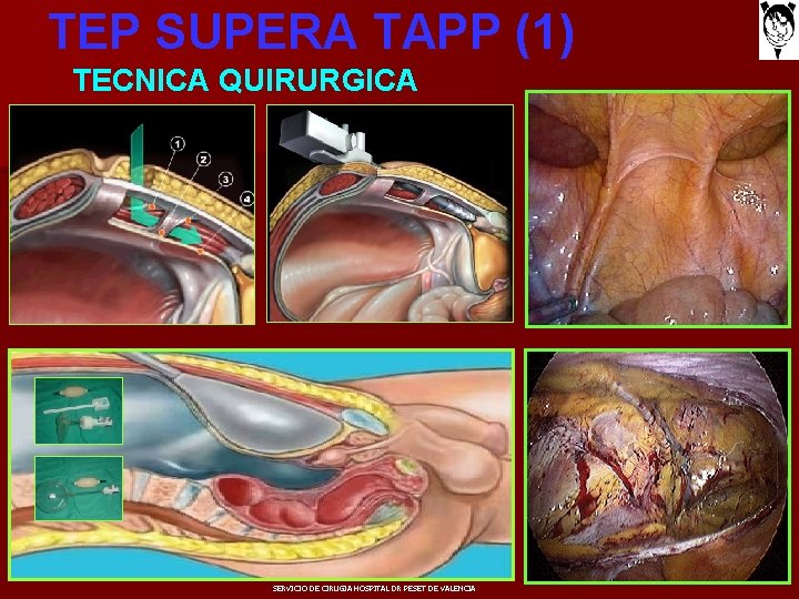 TEP SUPERA TAPP (1) TECNICA QUIRURGICA SERVICIO DE CIRUGIA HOSPITAL DR PESET DE VALENCIA