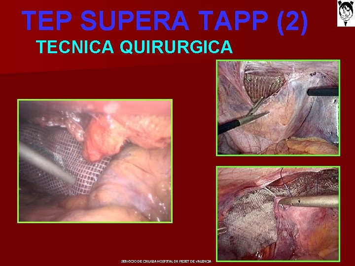 TEP SUPERA TAPP (2) TECNICA QUIRURGICA SERVICIO DE CIRUGIA HOSPITAL DR PESET DE VALENCIA
