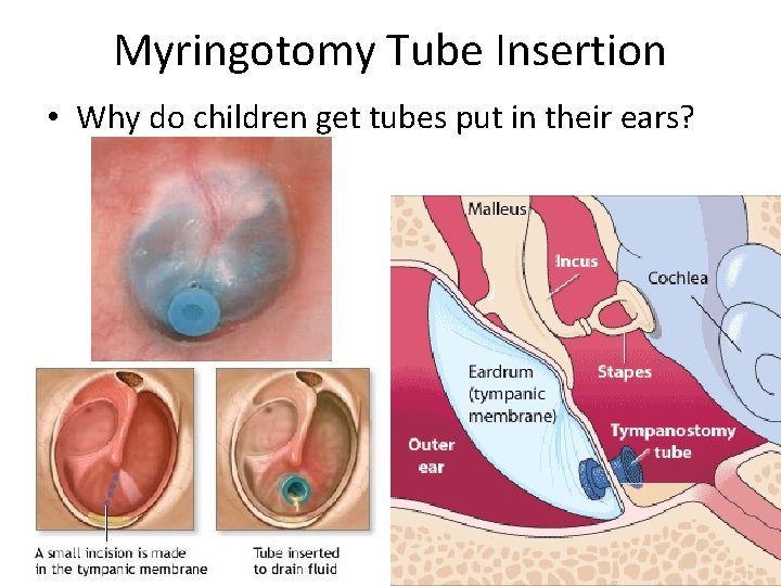 Myringotomy Tube Insertion • Why do children get tubes put in their ears? 
