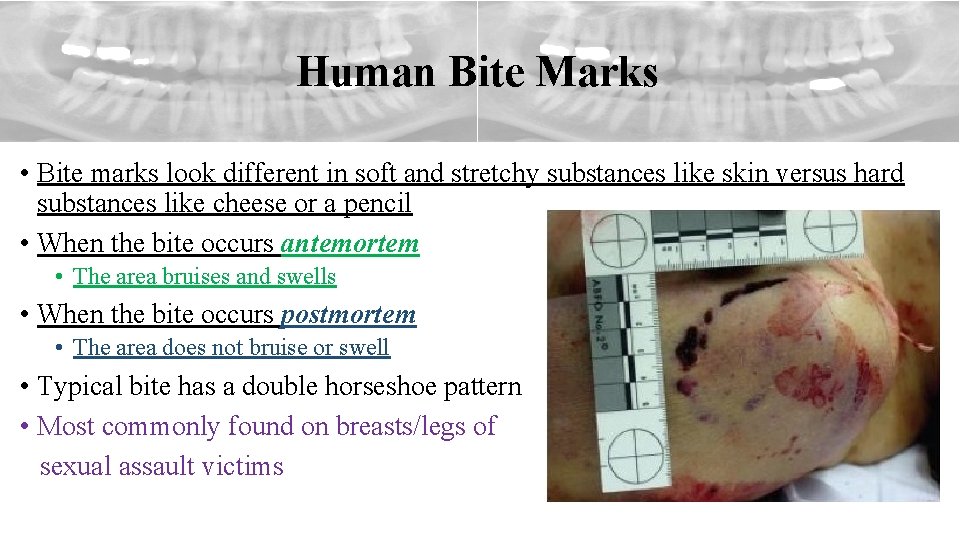 Human Bite Marks • Bite marks look different in soft and stretchy substances like