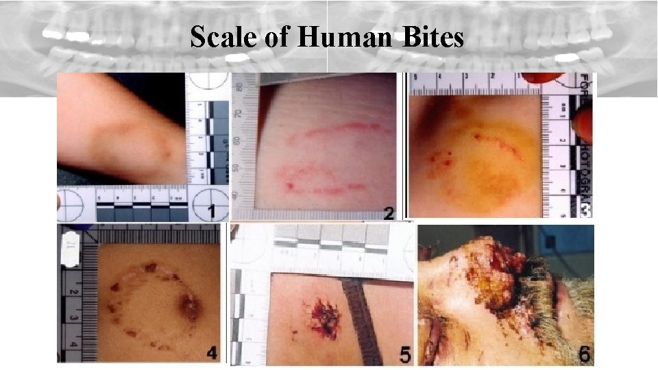 Scale of Human Bites 