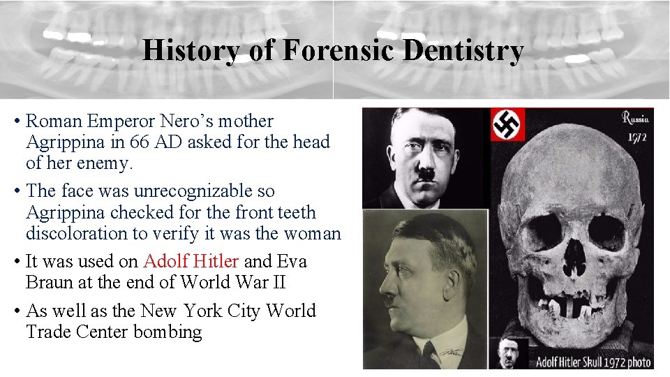 History of Forensic Dentistry • Roman Emperor Nero’s mother Agrippina in 66 AD asked