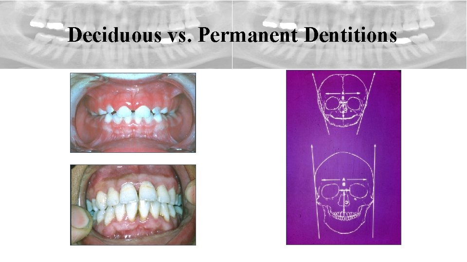 Deciduous vs. Permanent Dentitions 