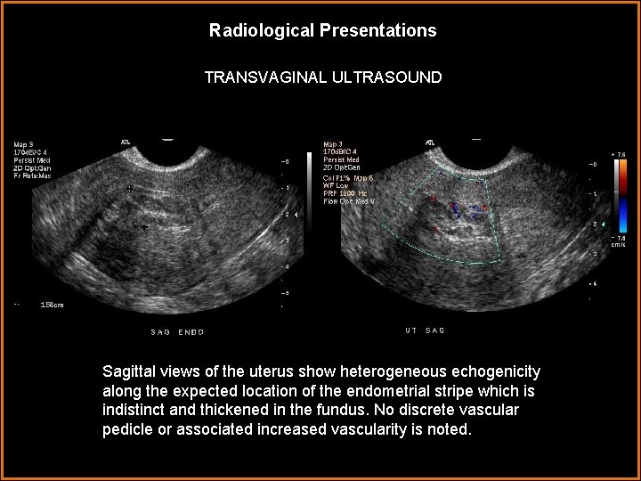 Radiological Presentations TRANSVAGINAL ULTRASOUND Sagittal views of the uterus show heterogeneous echogenicity along the