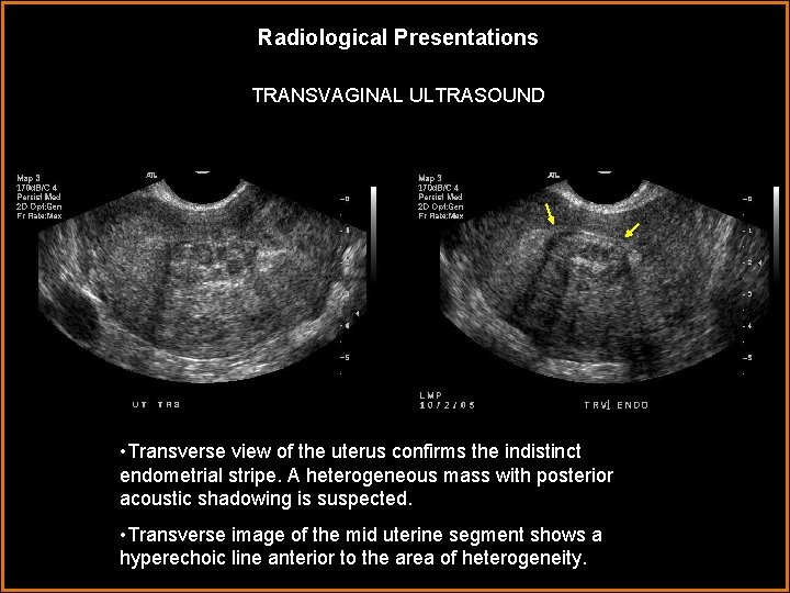 Radiological Presentations TRANSVAGINAL ULTRASOUND • Transverse view of the uterus confirms the indistinct endometrial