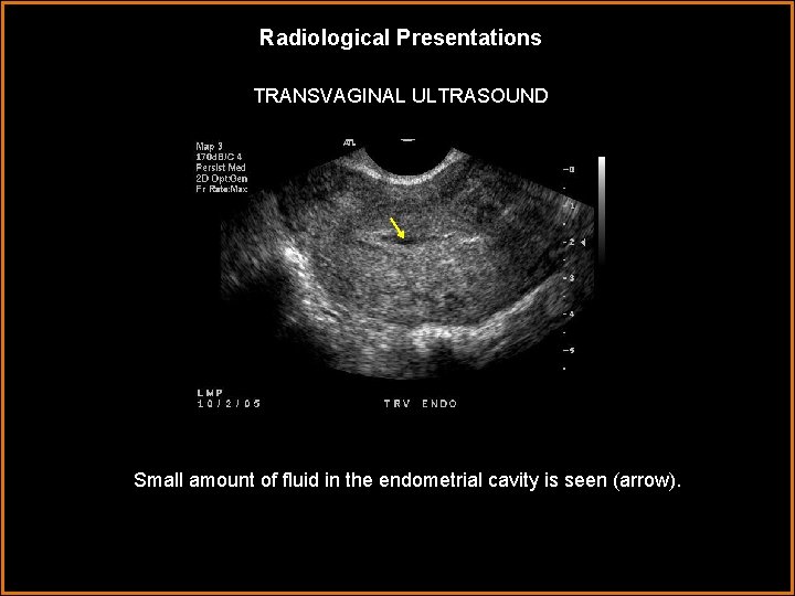 Radiological Presentations TRANSVAGINAL ULTRASOUND Small amount of fluid in the endometrial cavity is seen