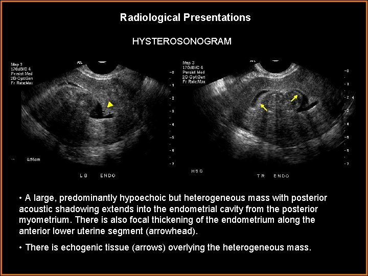 Radiological Presentations HYSTEROSONOGRAM • A large, predominantly hypoechoic but heterogeneous mass with posterior acoustic