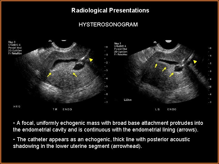 Radiological Presentations HYSTEROSONOGRAM • A focal, uniformly echogenic mass with broad base attachment protrudes